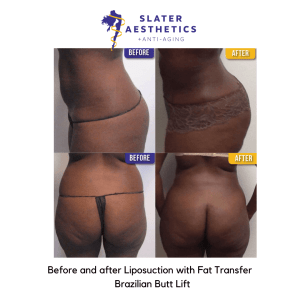 Before and 1 day after Liposuction and fat transfer to the buttocks - BBL Brazilian Butt Lift by Dr. Monte Slater