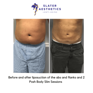 Before and after Liposuction of the abs, flanks, and 2 posh body slim by Dr. Monte Slater
