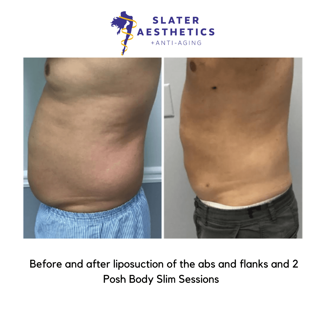 Vampire Breast Lift Thermi Breast Lift Fat Transfer to the Breasts