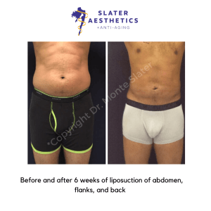 Before and after 6 weeks of liposuction of abdomen flanks and back