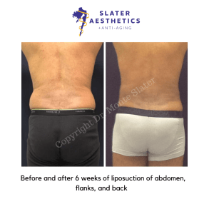 Before and after Liposuction of the abs, flanks, and low back by Dr. Monte Slater at Slater Aesthetics