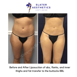 Before and after liposuction of abs, flanks, and inter thighs and fat transfer to the buttocks - BBL Brazilian Butt Lift by Dr. Monte Slater