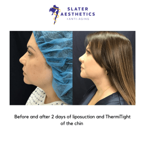 Before and after 2 days of liposuction and ThermiTight of the chin