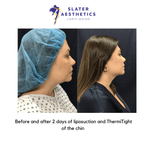 Before and After 2 Days of Liposuction and Thermitight of the chin by Dr. Monte Slater