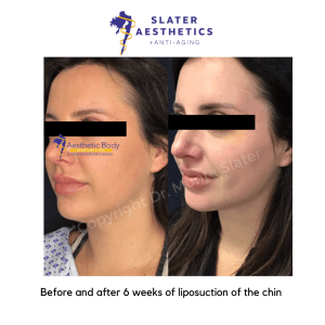 Before and after 6 Weeks of liposuction of the chin by Dr. Monte Slater