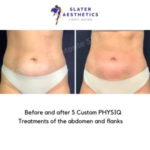 Before and after 5 custom treatments with PHYSIQ