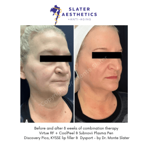 Before and after Combination Therapy with Virtue RF, CoolPeel, Subnovii 8 week result