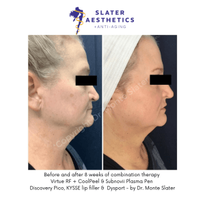 Before and after Combination Therapy with Virtue RF, CoolPeel, Subnovii 8 week result