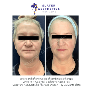 Before and after Combination Therapy with Virtue RF, CoolPeel, Subnovii 8 week result