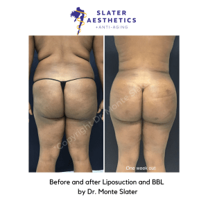 Brazilian Butt Lift Before and After Liposuction and Fat Transfer by Dr. Monte Slater