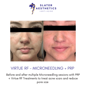 Before and after Multiple Microneedling Sessions with PRP + Virtue RF Treatments to treat acne scars and reduce pore sizes by Dr. Monte Slater