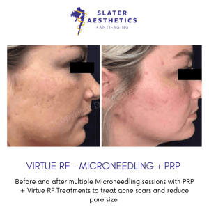 Before and After Virture RF, PRP, & Microneedling