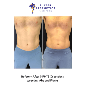 Before + After 5 PHYSIQ sessions targeting Abs and Flanks