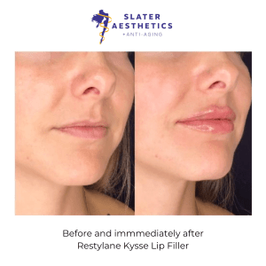 Before and after Restylane Kysse Lip Filler