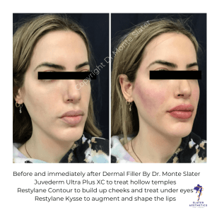 Before and after Dermal Filler by Dr Monte Slater