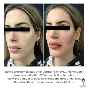 Before and after Dermal Filler by Dr Monte Slater