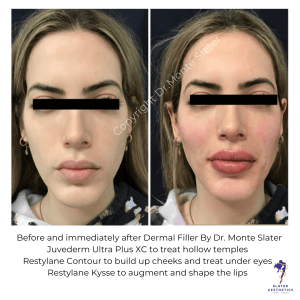 Before and after Dermal Filler by Dr Monte Slater