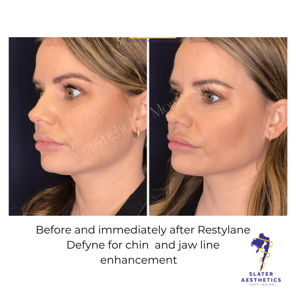 Brazilian Butt Lift & Sculptra Butt Lift Results - Dr. Monte Slater