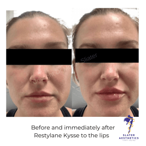 Before and immediately after Restylane Kysse