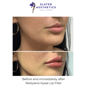 Before and immediately After Restylane Kysse Lip Filler