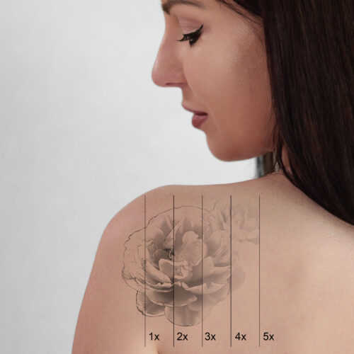 Laser Tattoo Removal On Woman's Shoulder by Discovery pico Laser Technology in Atlanta Location