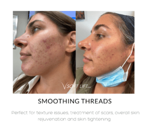 VSoft- Smoothing Threads Perfect for texture issues, treatment of scars, overall skin rejuvenation and skin tightening.