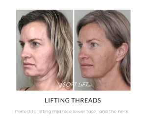 V Soft Lift - Lifting Threads Perfect for lifting mid face lower face and the neck