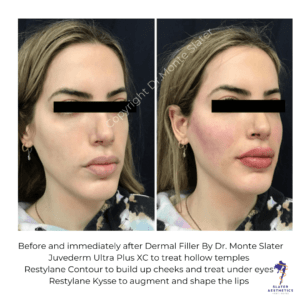 Before and After Dermal filler Results by Dr Monte Slater Juvederm Ultra Plus XC to treat hollow temples. Restylane Contour to build up cheeks and treat under eyes Restylane Kysse to augment and shape the lips.