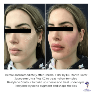 Before and After Dermal filler Results by Dr Monte Slater Juvederm Ultra Plus XC to treat hollow temples.