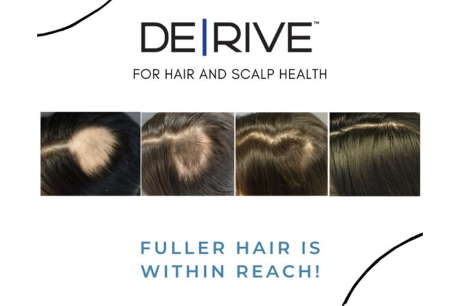 Exploring the Benefits of DE|Rive Hair Restoration’s Plant-Based Growth Factors