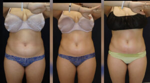 30 year old Before and after 3 Posh Body Slim Body Contouring Sessions – Treatment Goal Fat Reduction & Skin Tightening