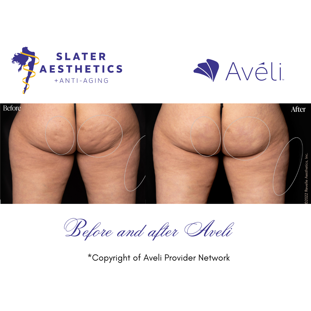 Before and After Aveli results