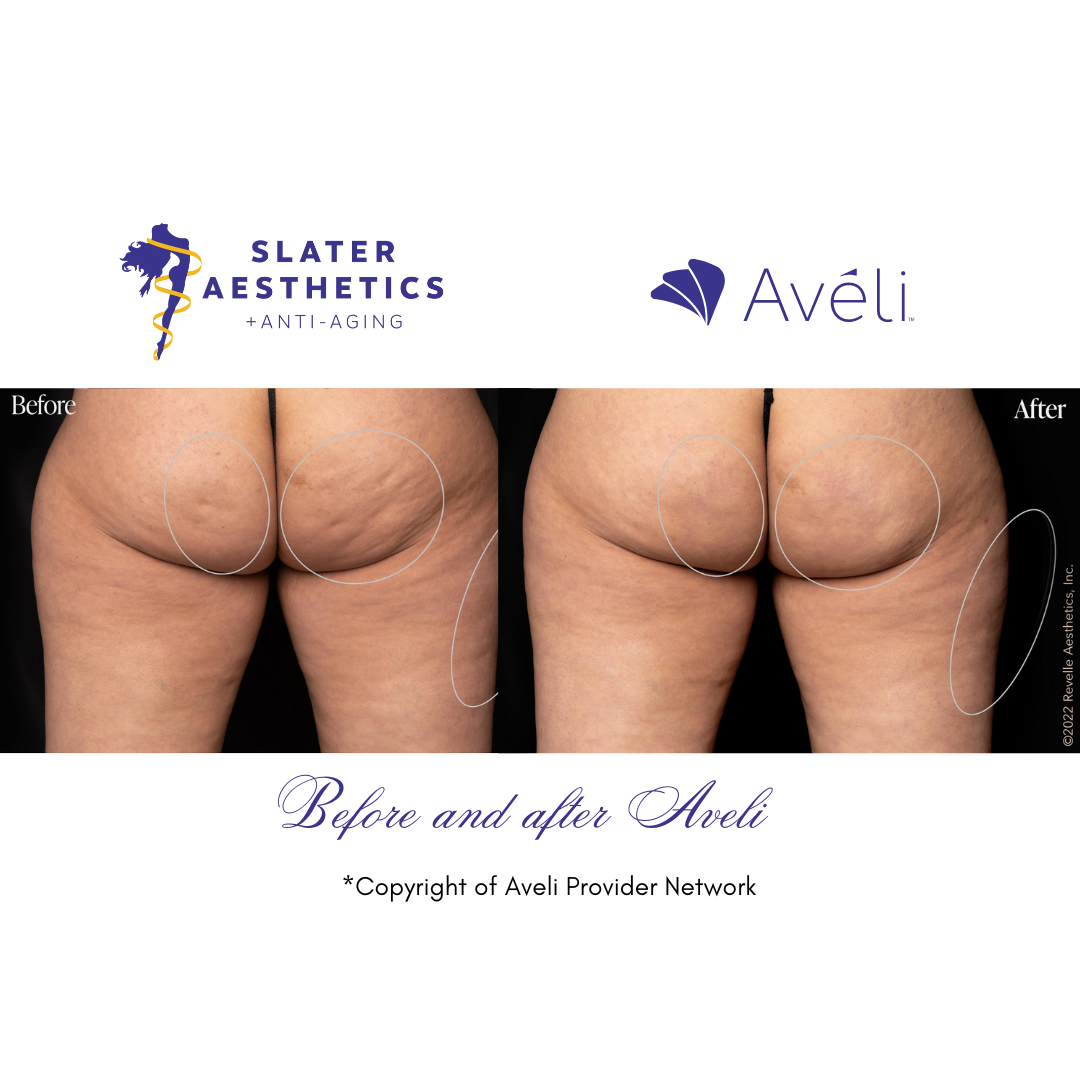 Before and After Aveli Results