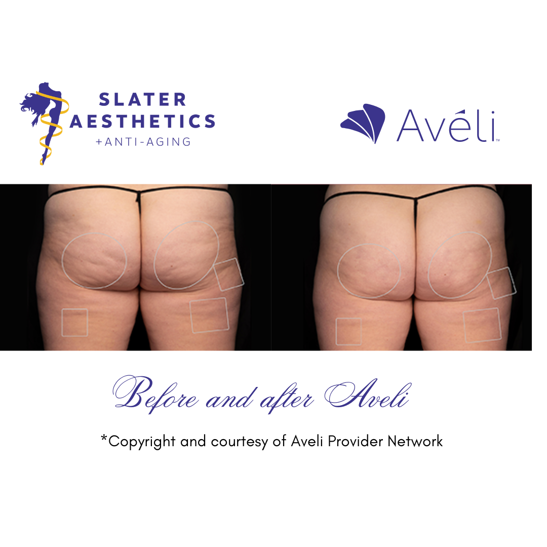 Before and After Aveli results at Slater Aesthetics