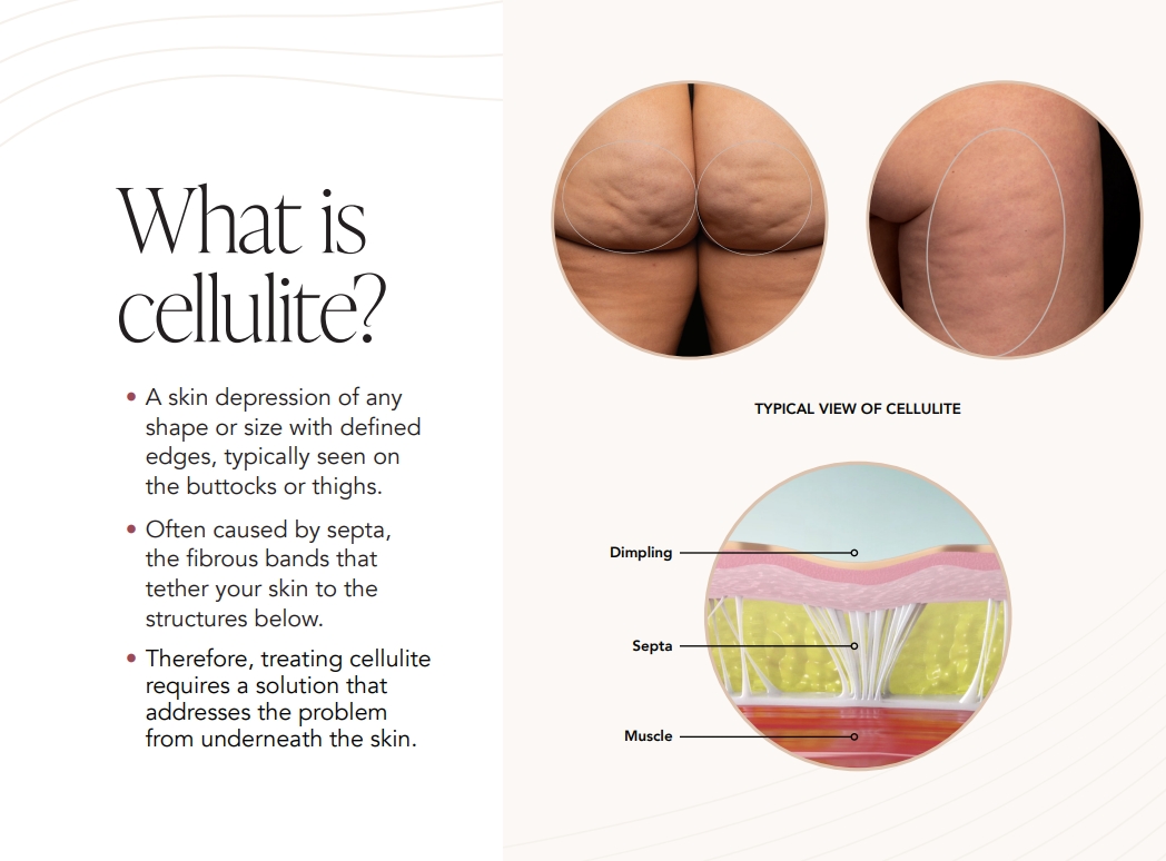 what is cellulite?