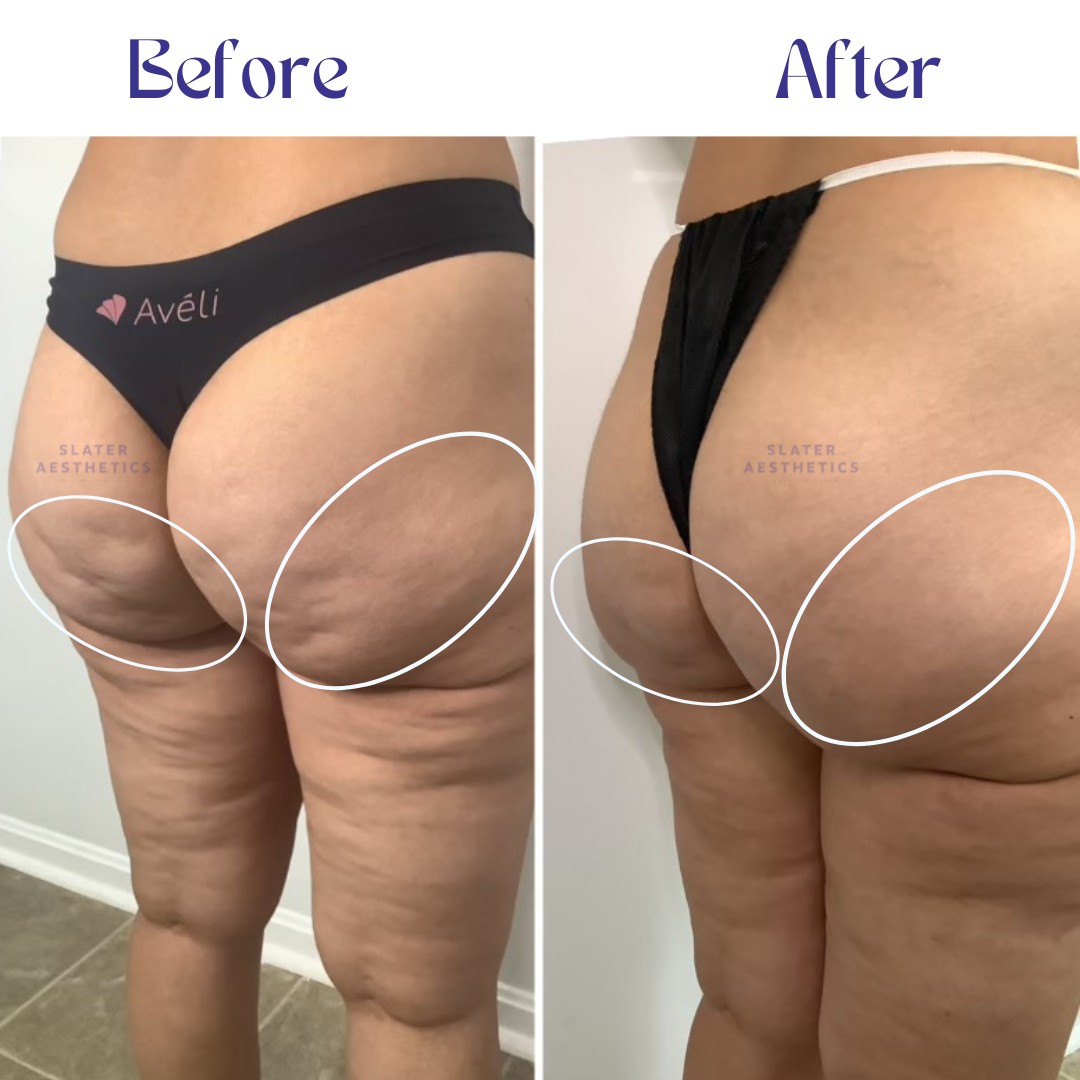 real cellulite treatment results. before and after treatment of patient that used Aveli in Atlanta georgia.