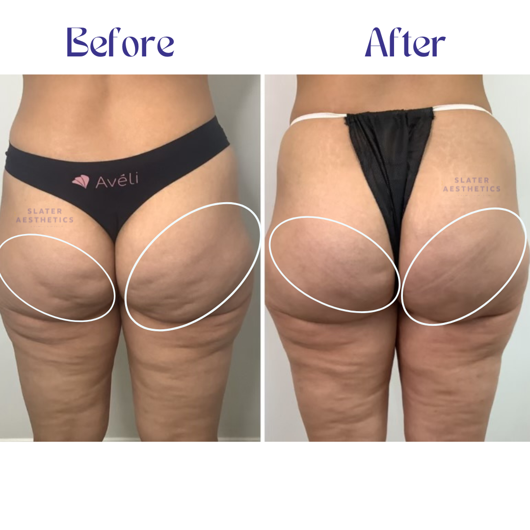 real cellulite treatment results. before and after treatment of patient that used Aveli in Atlanta georgia.