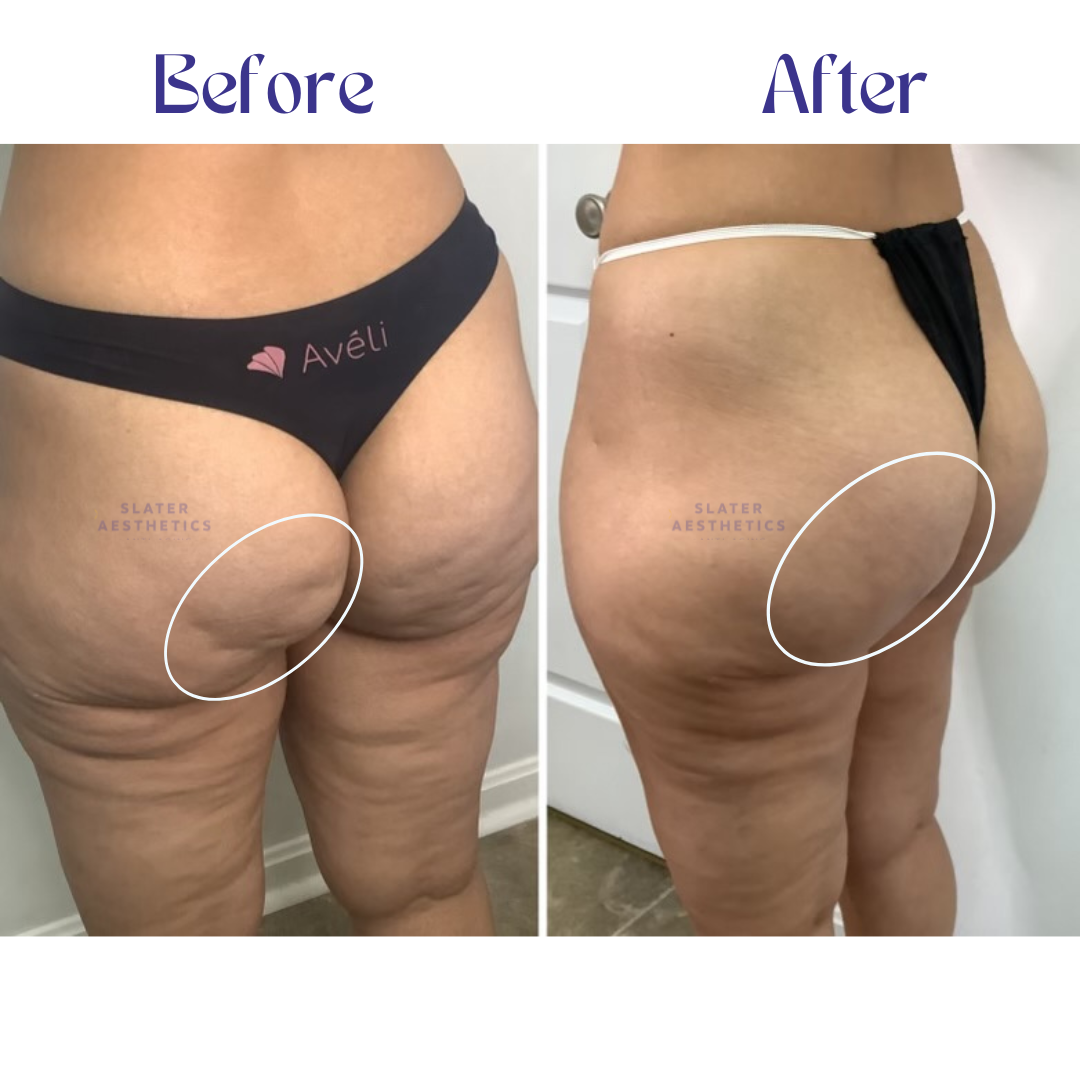 real cellulite treatment results. before and after treatment of patient that used Aveli in Atlanta georgia.