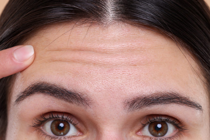 How Long Does Botox Last for Forehead Wrinkles?