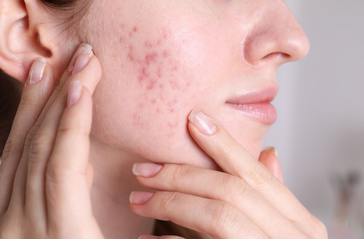 Hormonal Acne