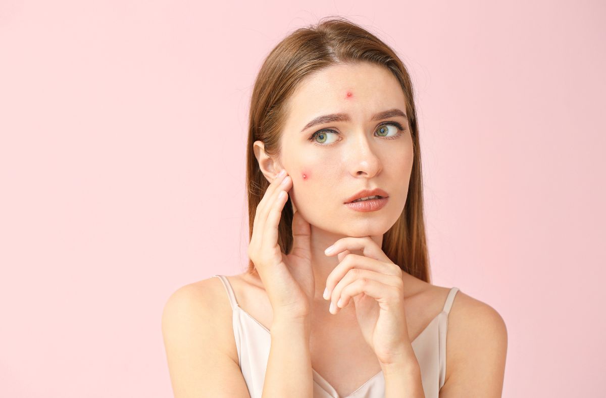 Hormonal Acne